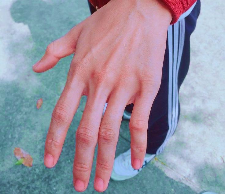 Синдром Марфана длинные пальцы