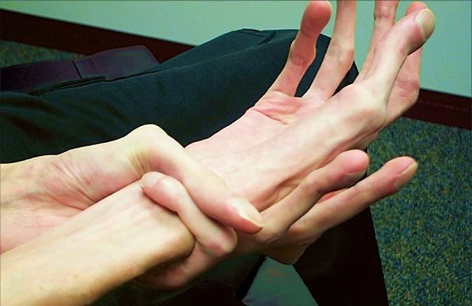Синдром Марфана длинные руки