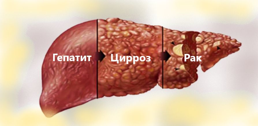 гепатит и цирроз